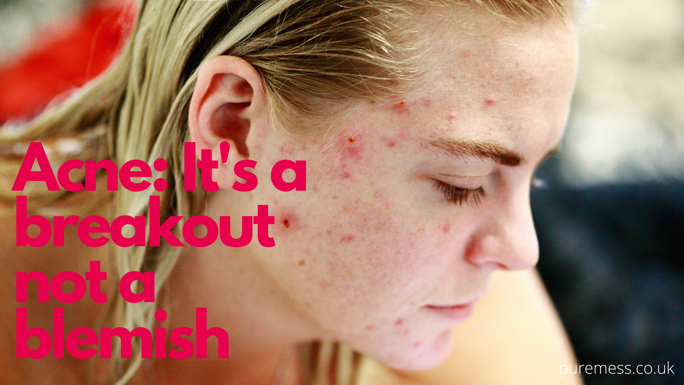 Adult Acne: Causes, Remedies, and Natural Skincare That Helps