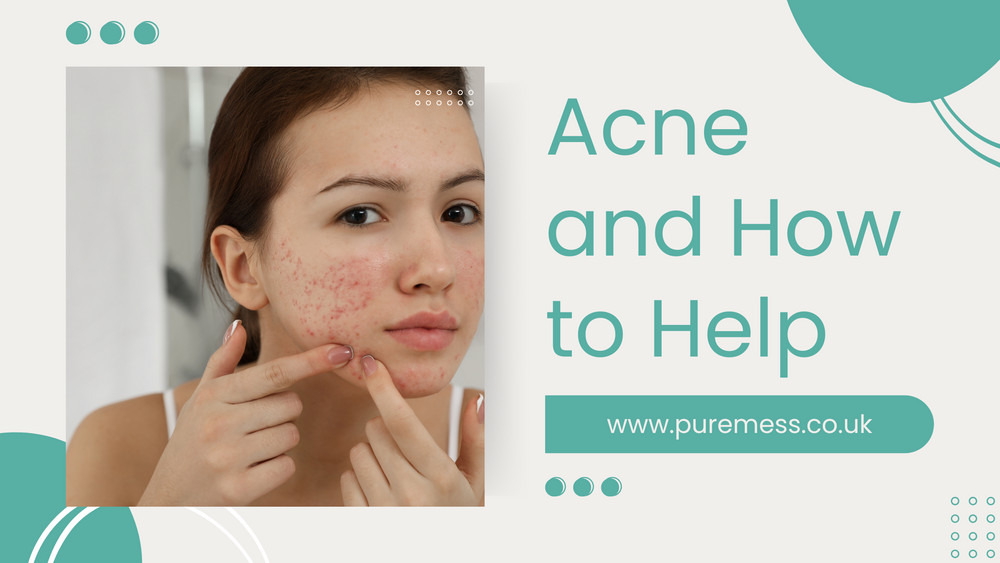 Types of Acne and How to Help