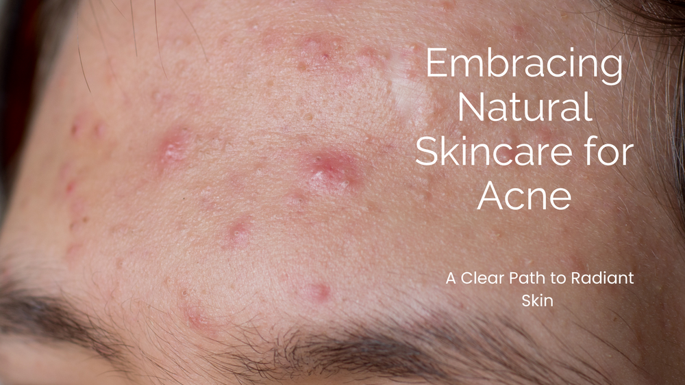 Embracing Natural Skincare for Acne: A Clear Path to Radiant Skin