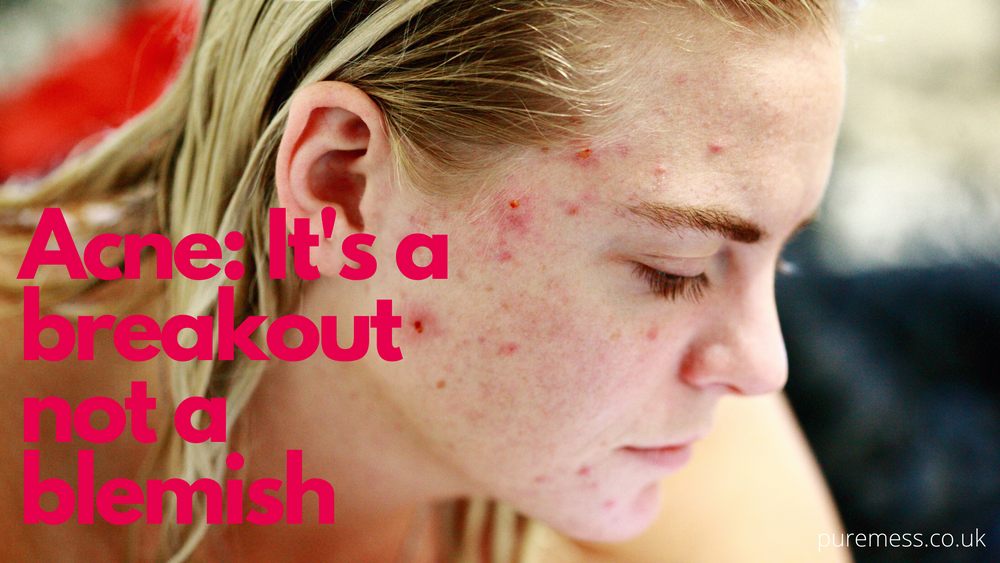 Acne in Adulthood: The Realities and Remedies